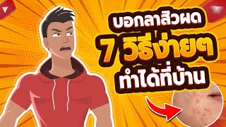 📌😍 บอกลาสิวผด 7 วิธีง่ายๆ ทำได้ที่บ้าน (แบบเร่งด่วน)