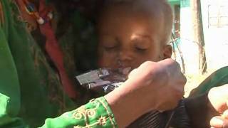 HealthPhone™ Amharic - 5 Appetite Testing Techniques - Management of Severe Acute Malnutrition