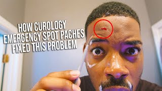 How Curology Emergency Spot Patches FIXED This Problem (With Proof)