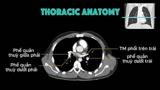 Giải phẫu ngực trên CT-scan