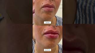 Dr. Alejandro Acuña | Relleno de Labios