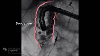 Lymphatic Embolization