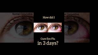 Eye flu Cure in 3 days 💙 #eyeflu #eyeflutreatment #eyeflunews #viral #ytshorts