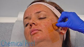 Chemical Peel Procedure At A Local Med Spa In San Antonio, Texas!