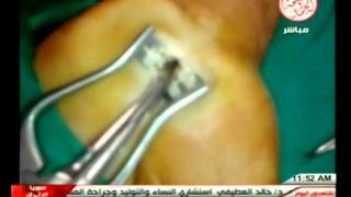 carpal tunnel release عملية تسليك عصب.flv