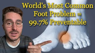 How to Prevent Bunions (6 Methods)