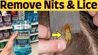 Get Rid Of Lice With Vinegar And Listerine - Remove Nits From Hair Without A Comb