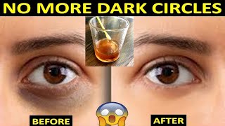 How To Reduce Dark Circles Under Eyes Naturally || Dark Circle Remedy At Home