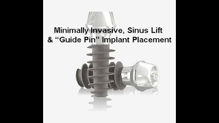 Minimally Invasive, Sinus Lift & Guide Pin Dental Implant Placement