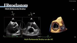 〖Echokardiografie〗 Lambl-Exkreszenzen & Fibroelastome im TEE 🫀