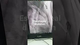 esophageal dilatation #class #study #diagnosticradiology #biology #kathmandupost #radiology