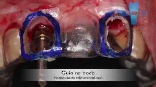 Guia cirúrgico anterior para cirurgia de instalação de implante imediato