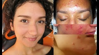 How I FINALLY cleared my acne NATURALLY | What caused my acne?