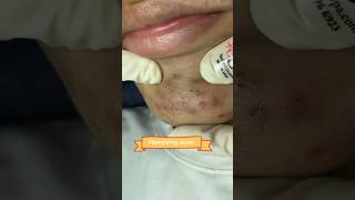 Removing acne/Blackheads #shortvideo #viral #acne #blackheads