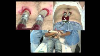 EWMA 2014 - Surgical Site Infection: Where Are We Today? - (3) A. Ramos Martinez