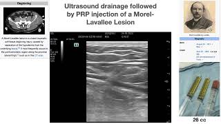 Ultrasound guided Drainage and PRP injection of a Morel-Levallee Lesion.