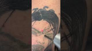 Tattoo of woman’s face on upper arm erased