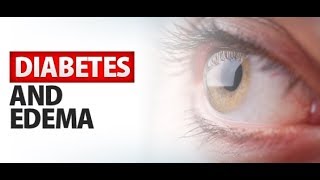 Diabetes and Edema