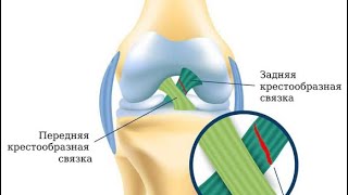 Реабилитация! Разрыв передней крестообразной связки.