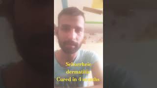 Seborrheic dermatitis fully cured in 4 month from 4 years patient incredible Amazing Transformation