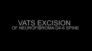 VATS(Thoracoscopic) excision  of dorsal spinal NEUROFIBROMA- Atul Mishra