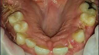 12 teeth extraction