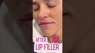 Happy Valentine's Season - Post Lip Filler!