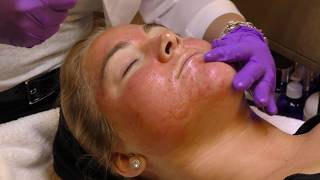 Learn More about Microneedling with Platelet Rich Plasma | Dr Jerome Lamb