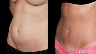 Incredible "Tummy Tuck" results for a mother of three. Only at 4 1/2 month post op.