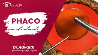 Phaco in Soft Cataract | Phacoemulsification | Best Eye Surgery Specialist in Hyderabad