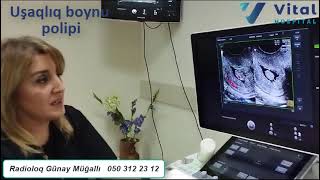 Uşaqlıq boynu polipi.USM həkimi  dr. Günay Muğallı. 050 312 23 12