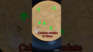 Calcium oxalate in Urine #health #youtubeshorts #microscope