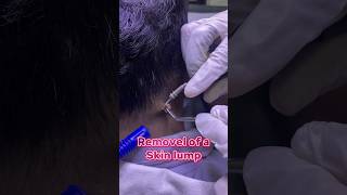 Removal of a skin lump  #skincare #skincenter #warts #skinlump #kandy