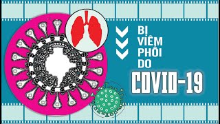 Bị viêm phổi do COVID-19 viêmphổi#viemphoi#viêmphổicấp#viemphoivuhan