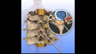 Posterior Cervical Foraminotomy Surgery Animation