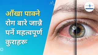 Viral Conjunctivitis अर्थात आँखा पाक्ने रोग बारे जान्नै पर्ने महत्वपूर्ण कुरा  | Pink Eye | Eye Flu