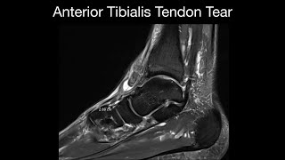 Anterior Tibialis Tendon Tear