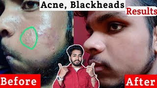 Acne, Blackheads Results Before and After Client