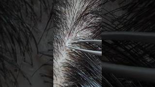 Home Treatments for Dandruff | How to Treat Dandruff at Home | Hair Care Tips | Home Remedies