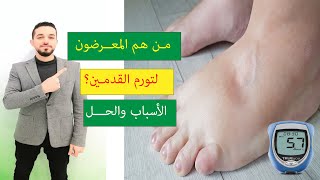 تورم وانتفاخ القدمين الأسباب والعلاج | هل السكري يسبب تورم القدمين؟