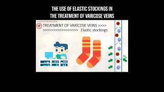 The use of elastic stockings in the treatment of varicose veins #stockings #varicoseveins #varicose