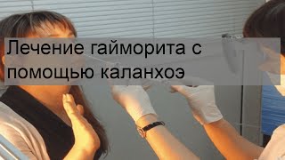 Лечение гайморита с помощью каланхоэ