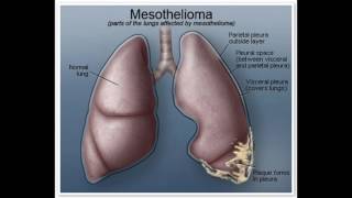 mesothelomia