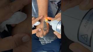 #tattoo #tattooremoval #remove #besttattooartist