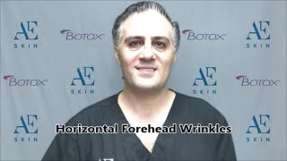 Horizontal Forehead Wrinkles - A E Skin -  Encino, CA - 818-835-1833