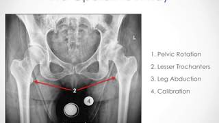 Templating For A Total Hip Replacement