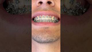 Why do my braces look like this!? 😱Pt.2