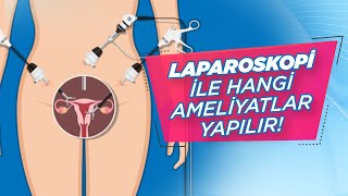 Kapalı Ameliyat Hangi Hastalıklarda Tercih Edilir? Laparoskopi Uygulanabilen Hastalıklar