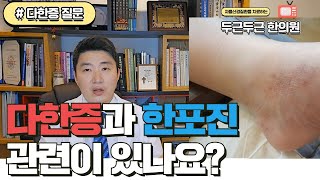 한포진과 다한증은 무슨 관계인가요? ㅣ다한증한의원 치료 (the treatment of eczema and hyperhidrosis )