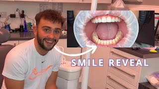 Ortho & Composite Veneers Reveal︱Smile Reveal